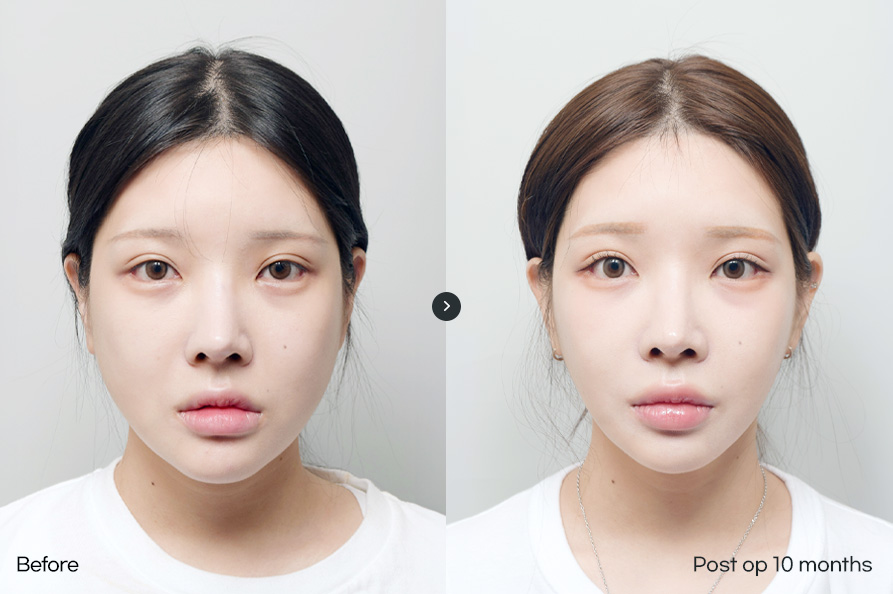 전후사진